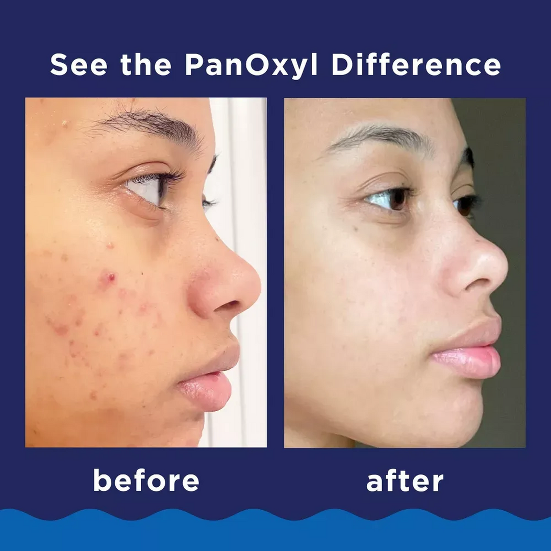PanOxyl غسول رغوي لحب الشباب 10% بنزويل بيروكسايد 156 جم